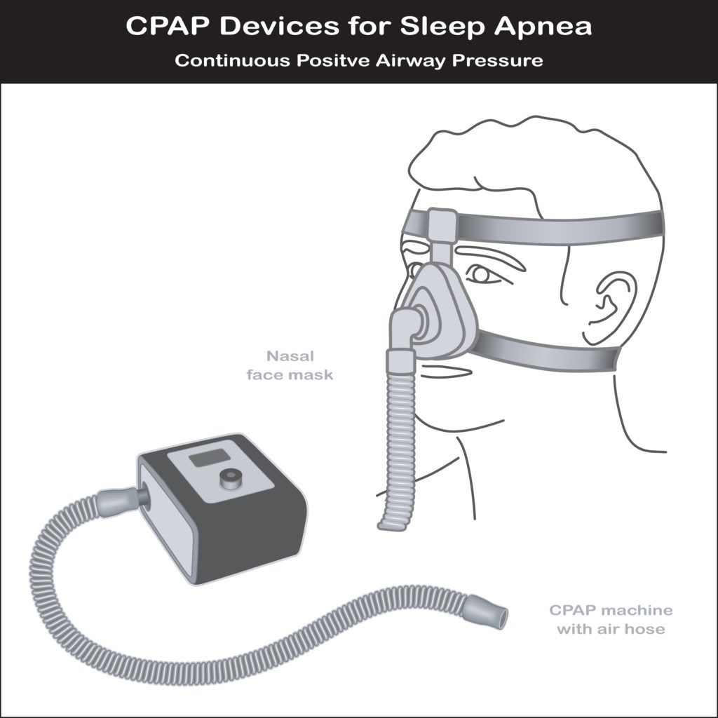 Continuous Positive Airway Pressure (CPAP)