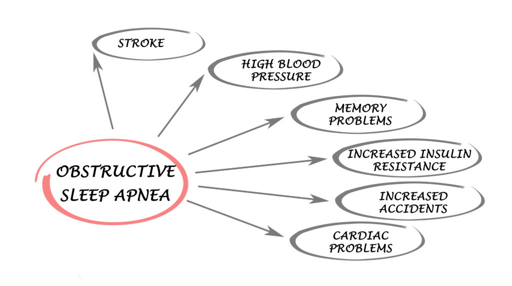 Obstructive Sleep Apnea