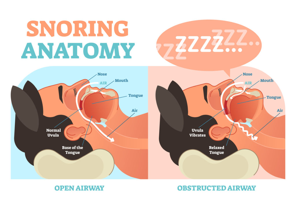 Can Nasal Dilators Prevent Snoring?