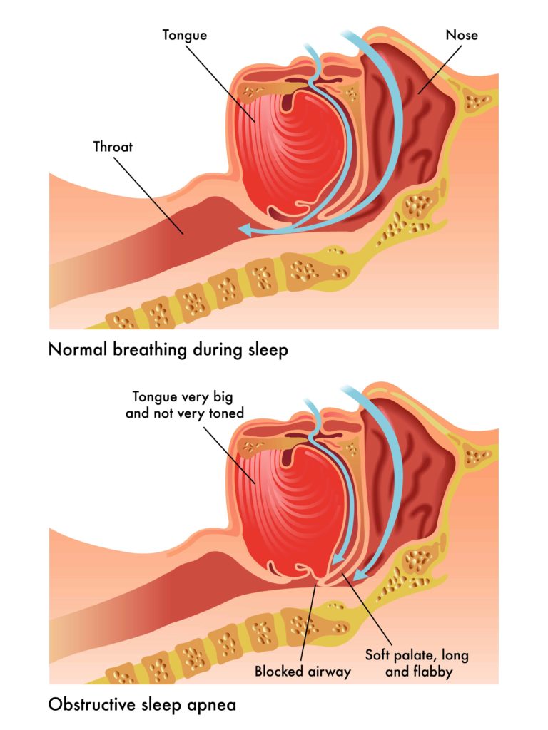 obstructive sleep apnea